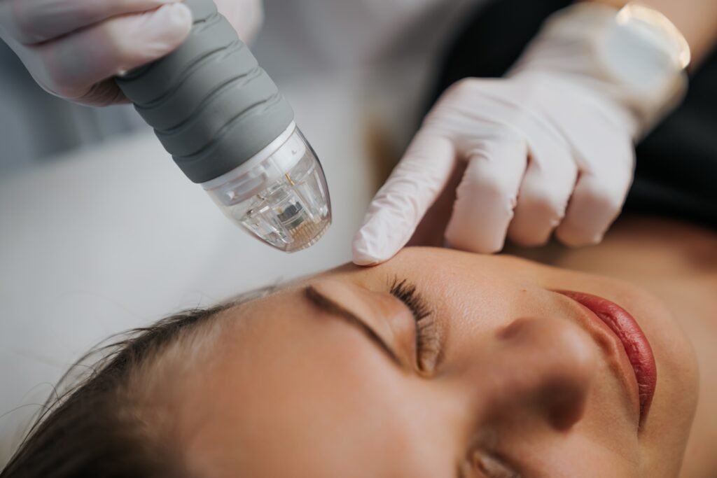 Microneedling | In Focus Aesthetics